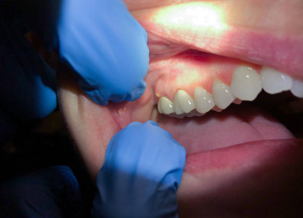 Best Emergency Treatment for Dental Infections or Abscesses in Williamsport, MD